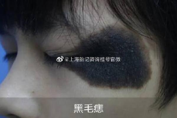 算命黑色胎记