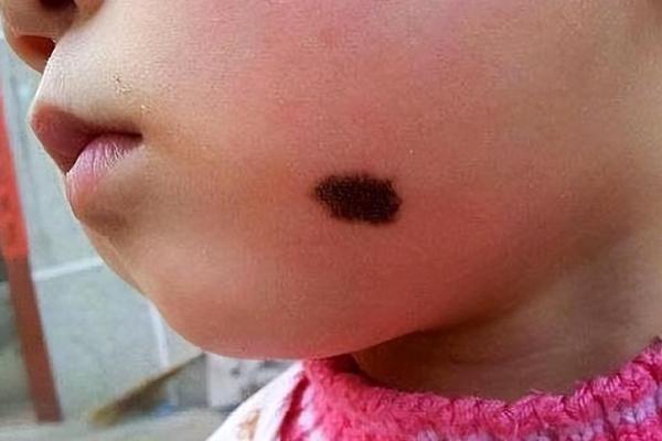 额头胎记算命有哪些影响-