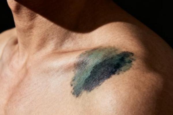 算命胎记 算命胎记