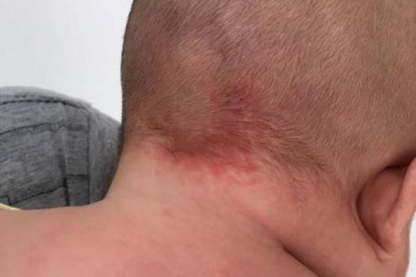 算命胎记 算命胎记