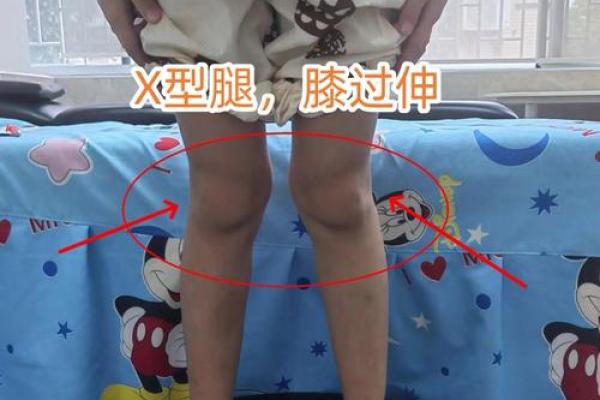 内八字腿 内八字腿