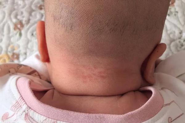 脖子上的胎记算命