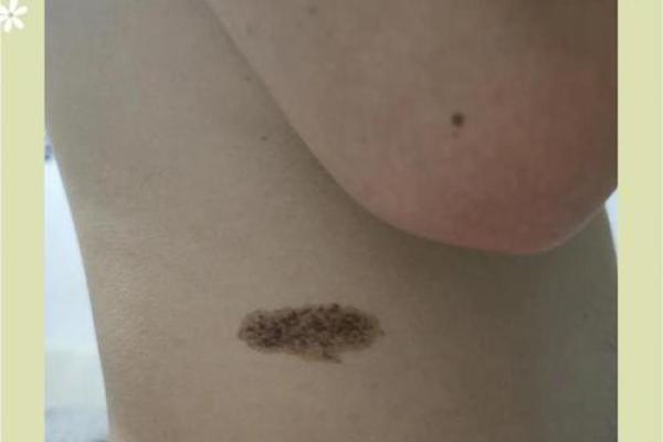 看胎记颜色类型算命 看胎记颜色类型算命