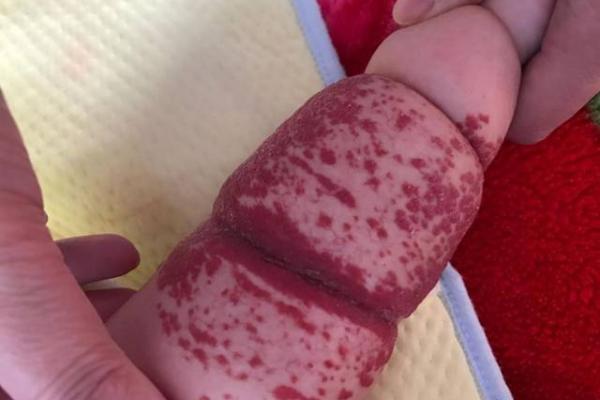 红色的胎记如何看相算命- 红色的胎记如何看相算命-