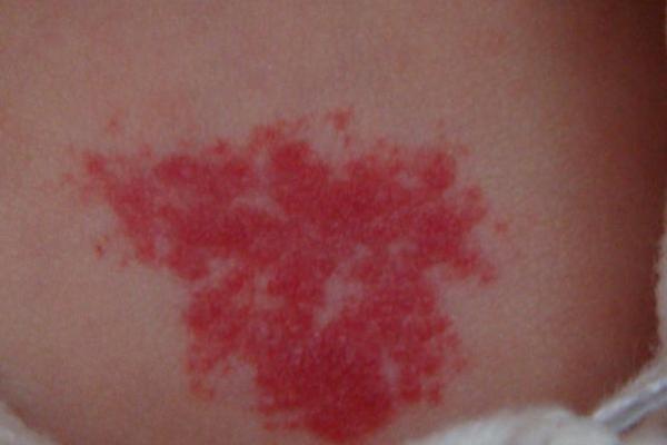 红色的胎记如何看相算命- 红色的胎记如何看相算命-