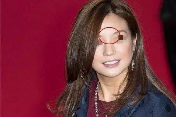 红色胎记算命看危害 红色胎记算命看危害