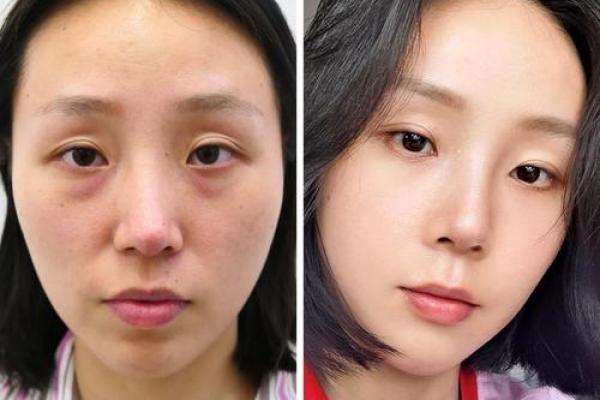 整容的八字 整容的八字