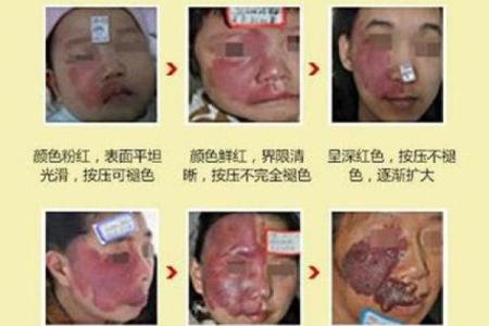 根据背部胎记算命