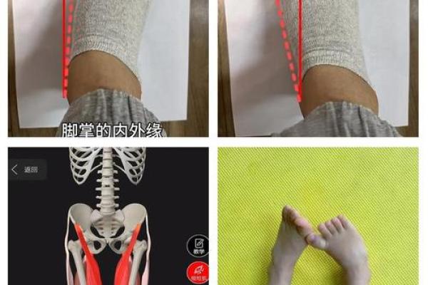 八字腿矫正 八字腿矫正