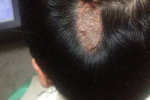 人体胎记算命的解释分析 人体胎记算命的解释分析