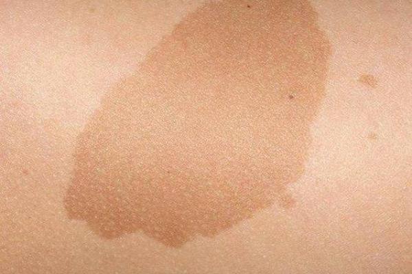 胎记算命的方法