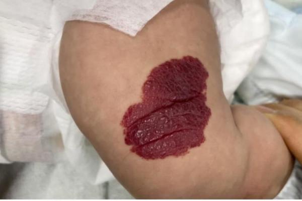 风水胎记胎记是红色的好吗危害