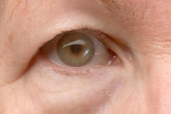 八字眼袋 八字眼袋