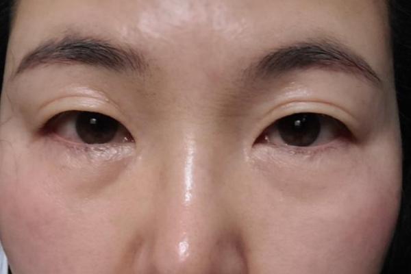 八字眼袋 八字眼袋