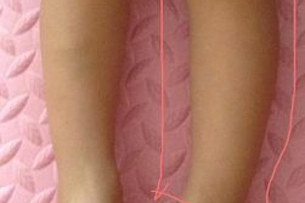 内八字腿型 内八字腿型