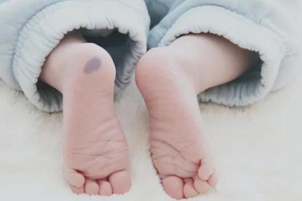 胎记位置算命看运势 胎记位置算命看运势