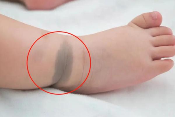 胎记位置算命看运势 胎记位置算命看运势