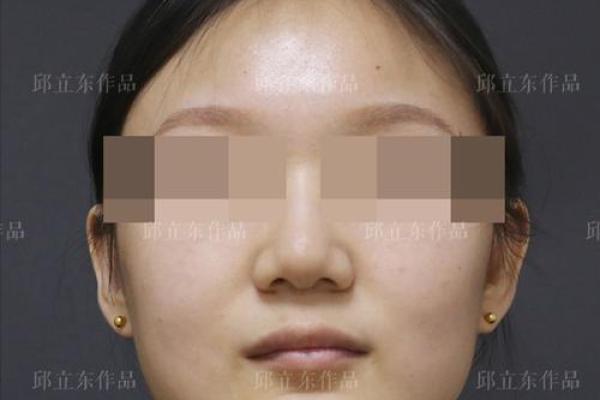 如何优化八字型下巴？