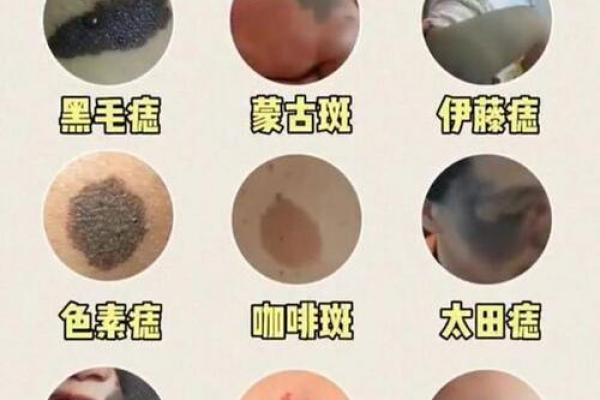 红胎记算命图解