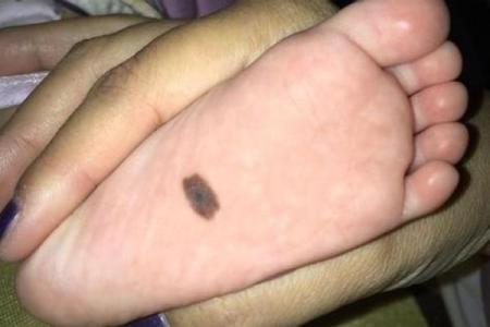 怎么看胎记算命-