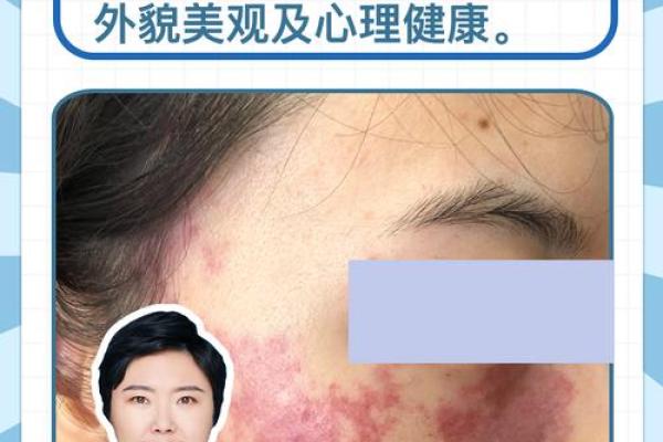 面部上的胎记算命分析