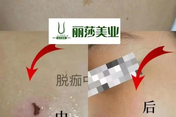 背部胎记算命，背部有胎记会怎样