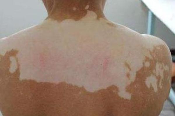 如何根据背部胎记算命- 如何根据背部胎记算命-