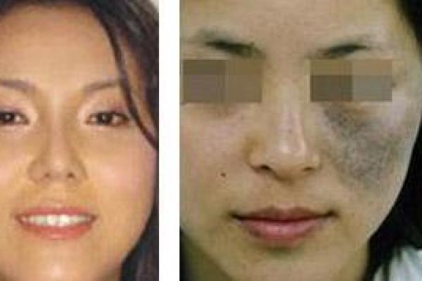 如何根据背部胎记算命- 如何根据背部胎记算命-