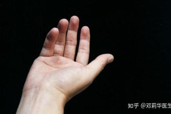 红胎记算命可不可靠