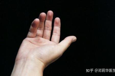 红胎记算命可不可靠